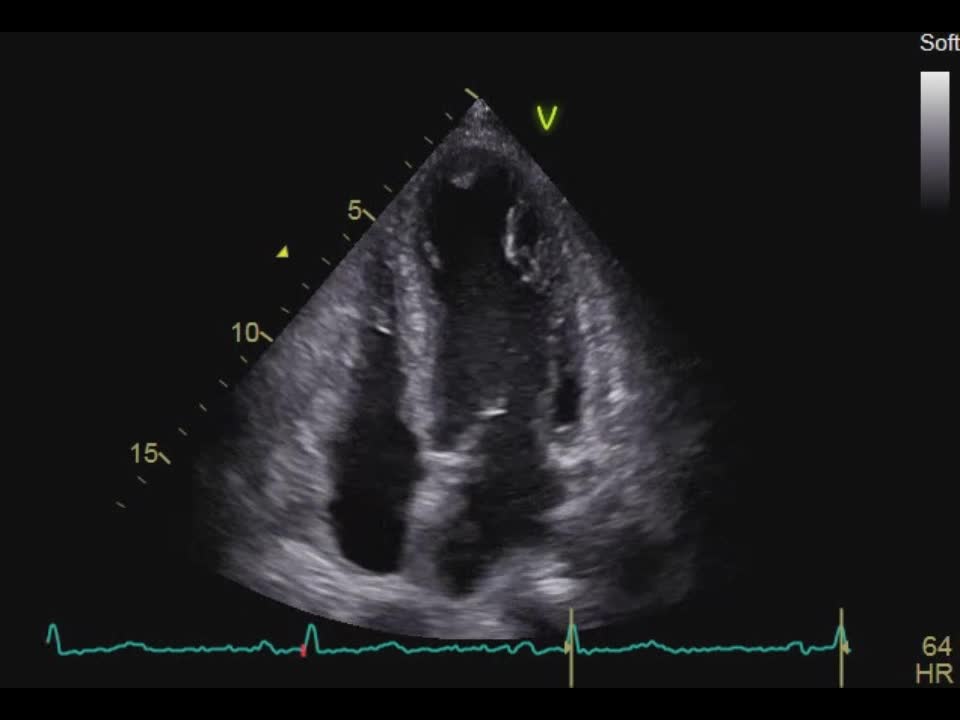 動画18-1　心エコー所見