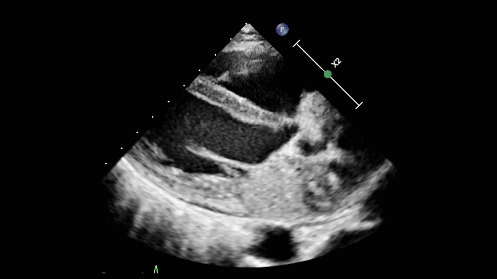 動画20-1　僧帽弁の心エコー①