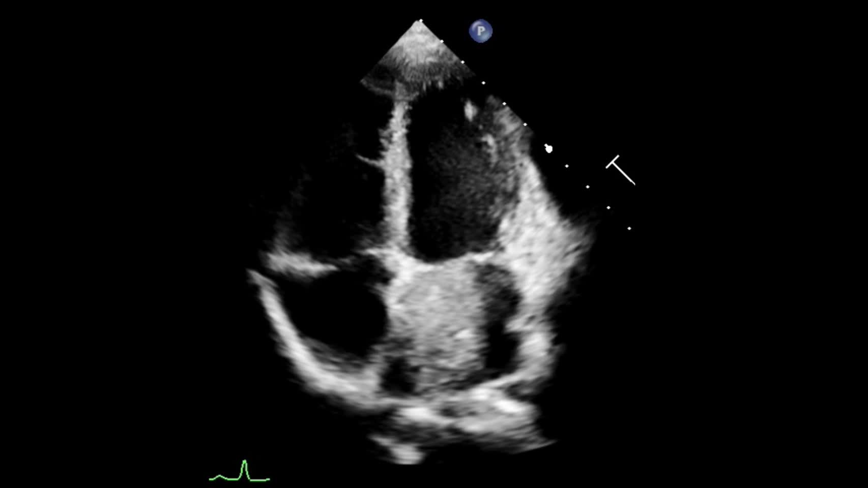 動画20-2　僧帽弁の心エコー②