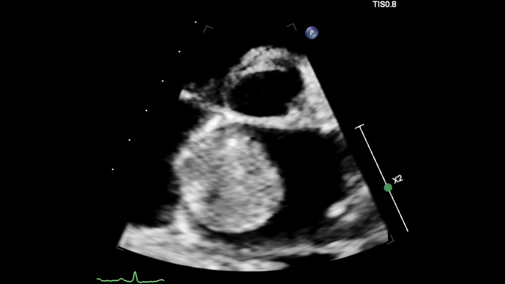 動画20-3　僧帽弁の心エコー③