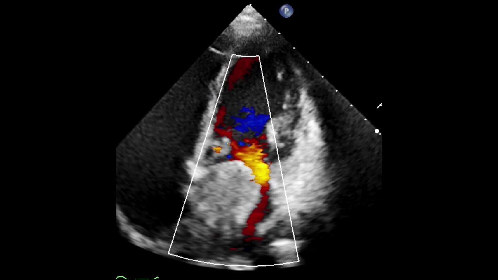 動画20-4　僧帽弁の心エコー④