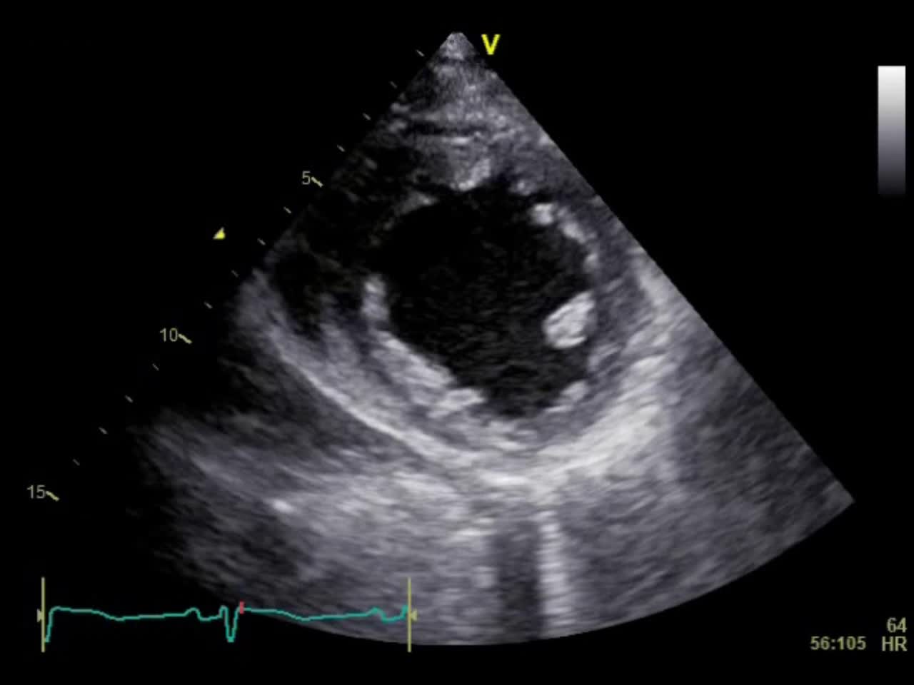 動画21-1　心エコー図（胸骨左縁短軸像）...