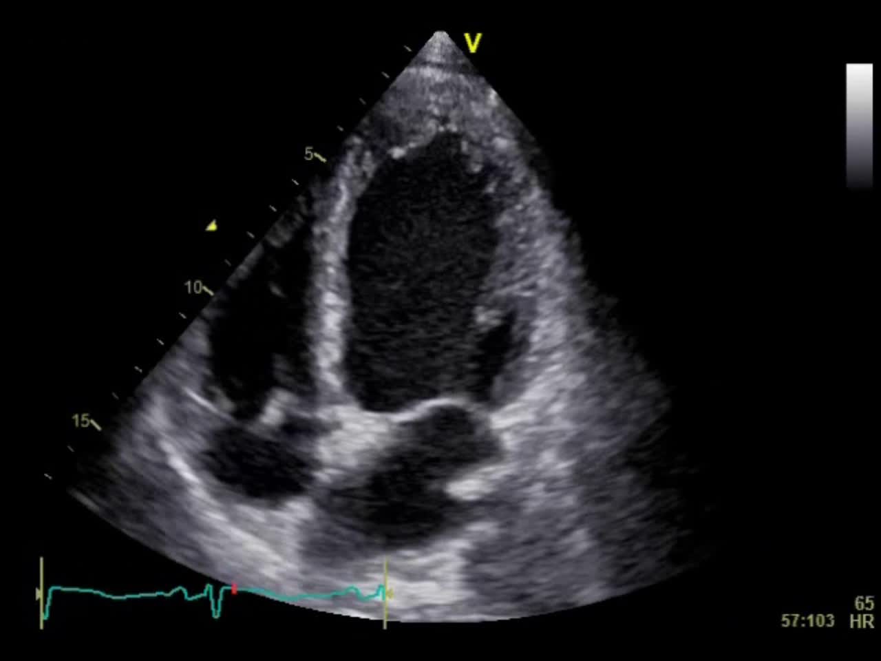 動画21-2　心エコー図（心尖部四腔像）...