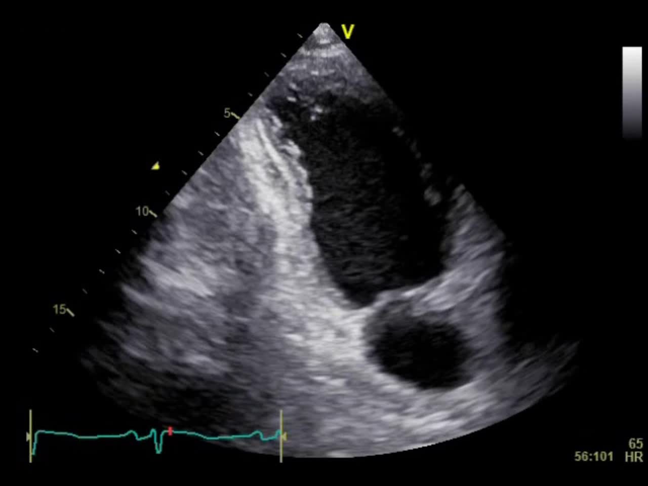 動画21-3　心エコー図（心尖部二腔像）...