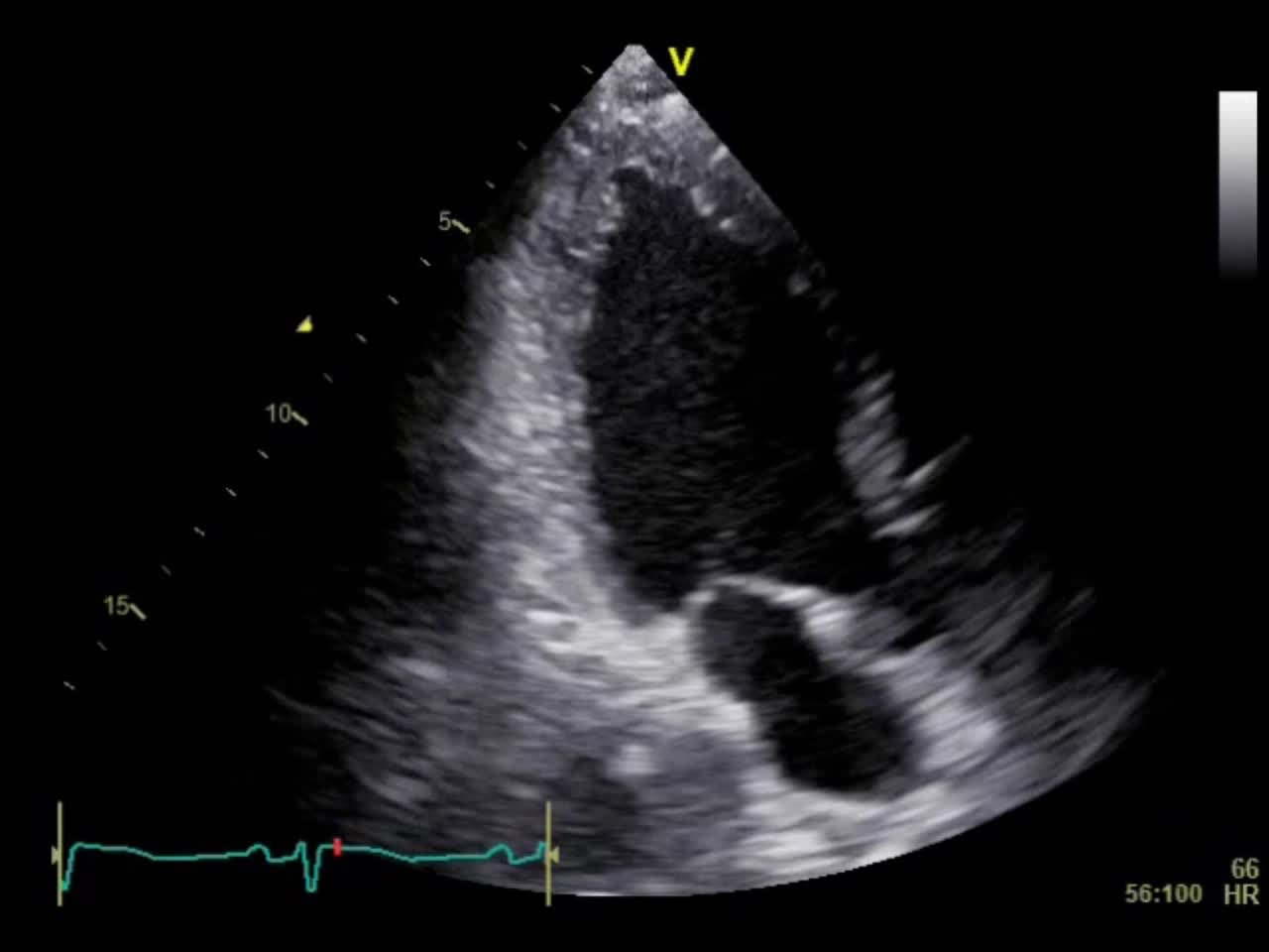 動画21-4　心エコー図（心尖部三腔像）...