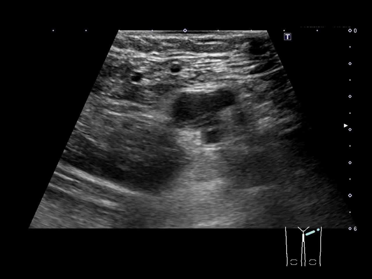 動画22-1　下肢エコー