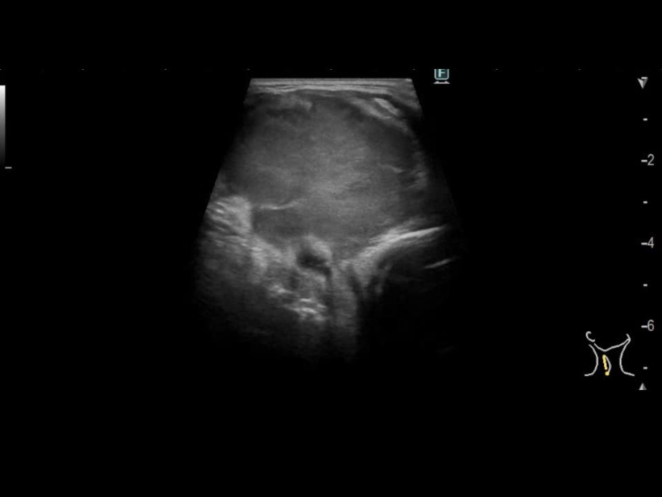 動画64-1　右鎖骨上腫瘤の超音波像