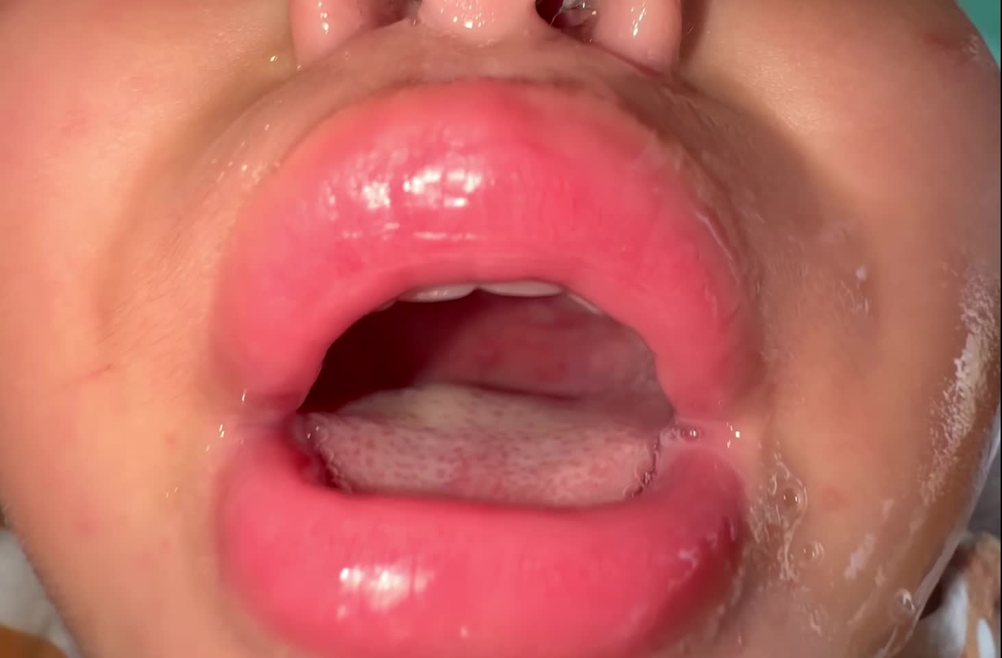 動画90-1　咽頭所見