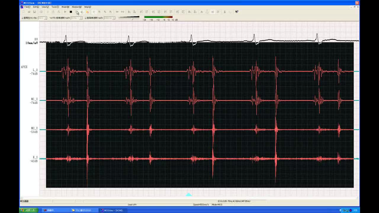 動画13-1　心尖部の心音