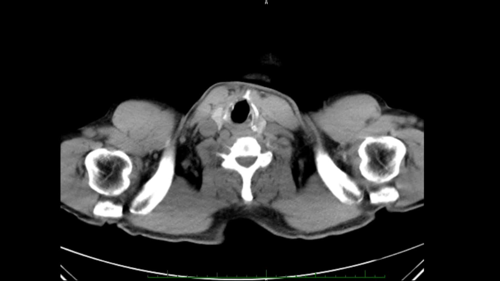 動画28-1　腹部単純CT