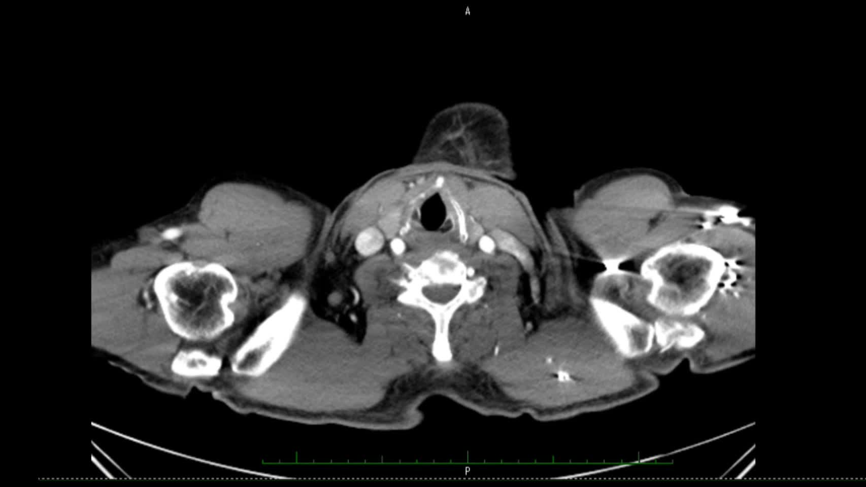 動画28-3　腹部造影CT（体軸断面）