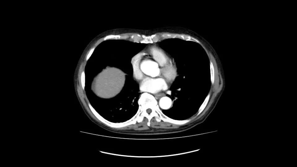 動画27-1　腹部造影CT