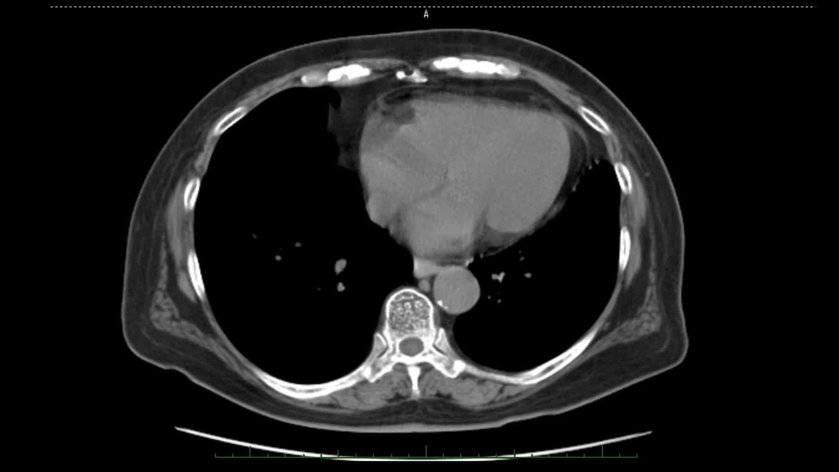 動画29-1　骨盤部CT