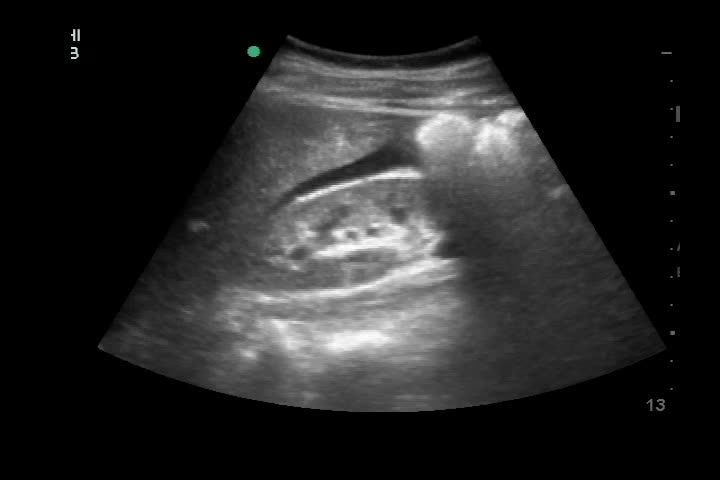 動画30-1　右上腹部エコー