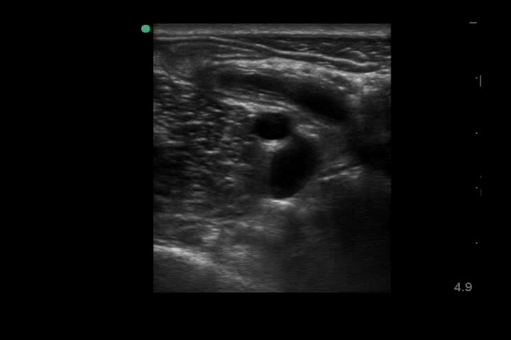 動画31-1　右下腹部エコー（長軸）