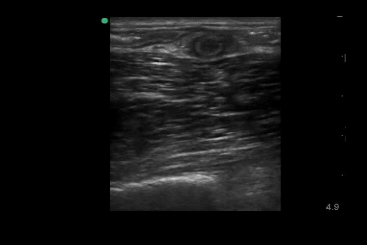 動画31-2　右下腹部エコー（短軸）