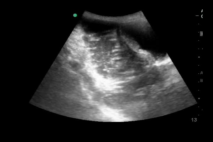 動画32-1　下腹部エコー