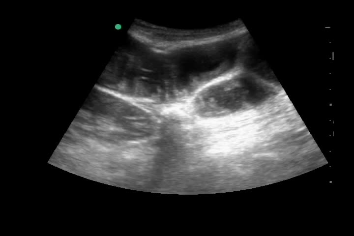 動画32-2　左腹部エコー