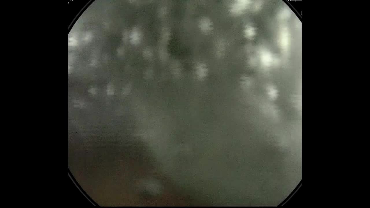 動画33-1　上部消化管内視鏡（画像強調内視鏡画像）...