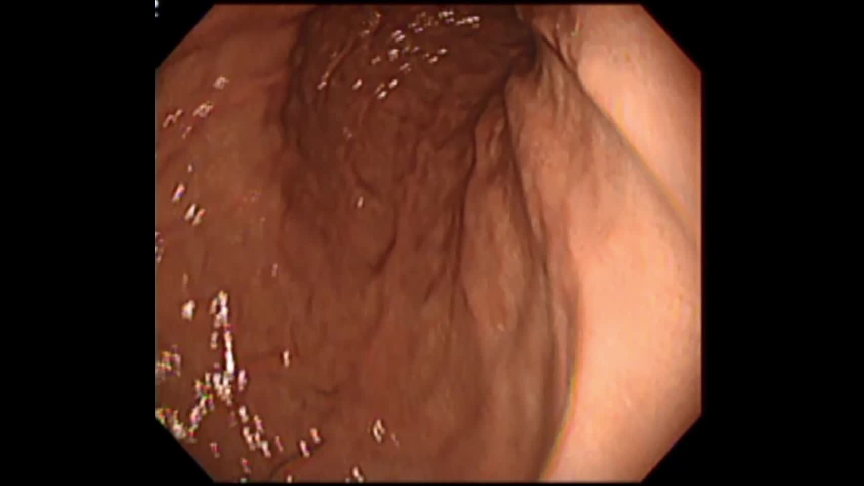 動画34-1　上部消化管内視鏡
