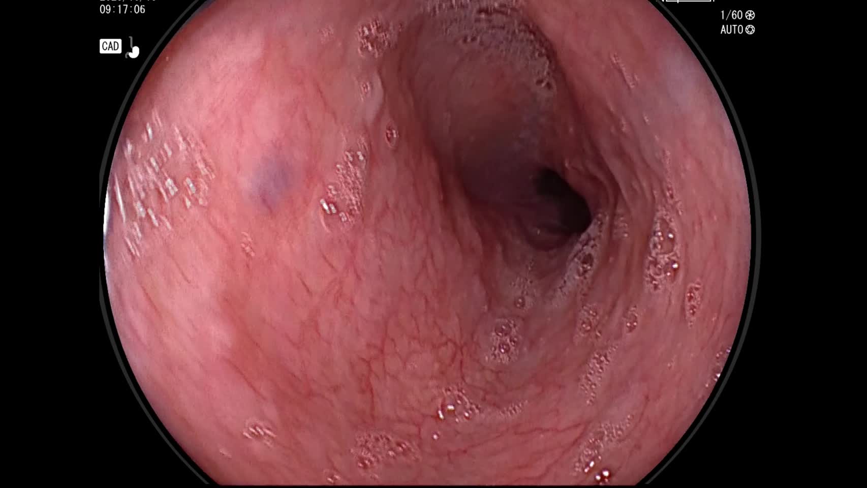 動画35-1　上部消化管内視鏡