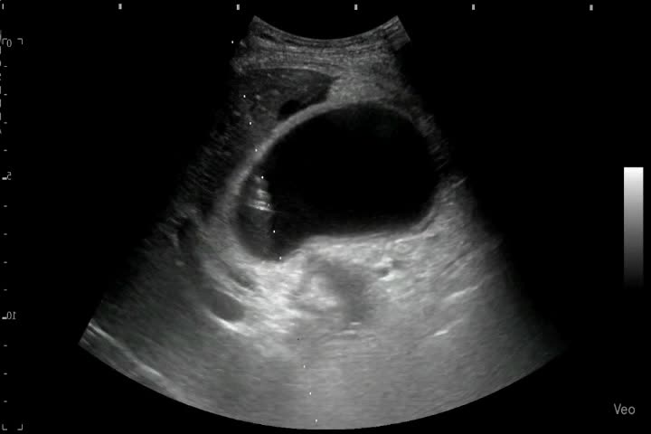 動画38-1　腹部エコー