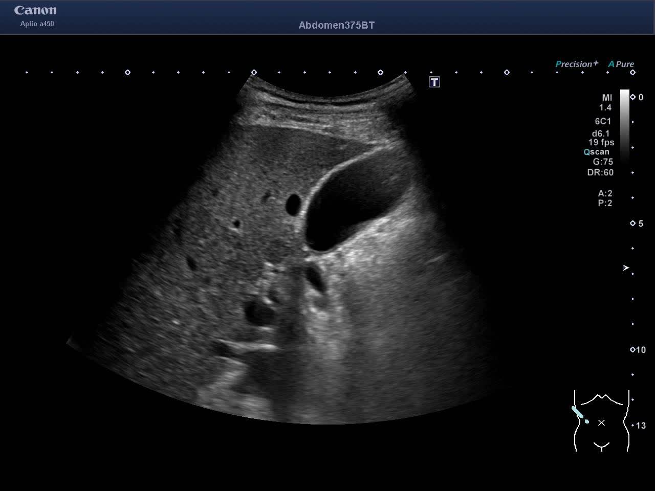 動画41-1　腹部エコー