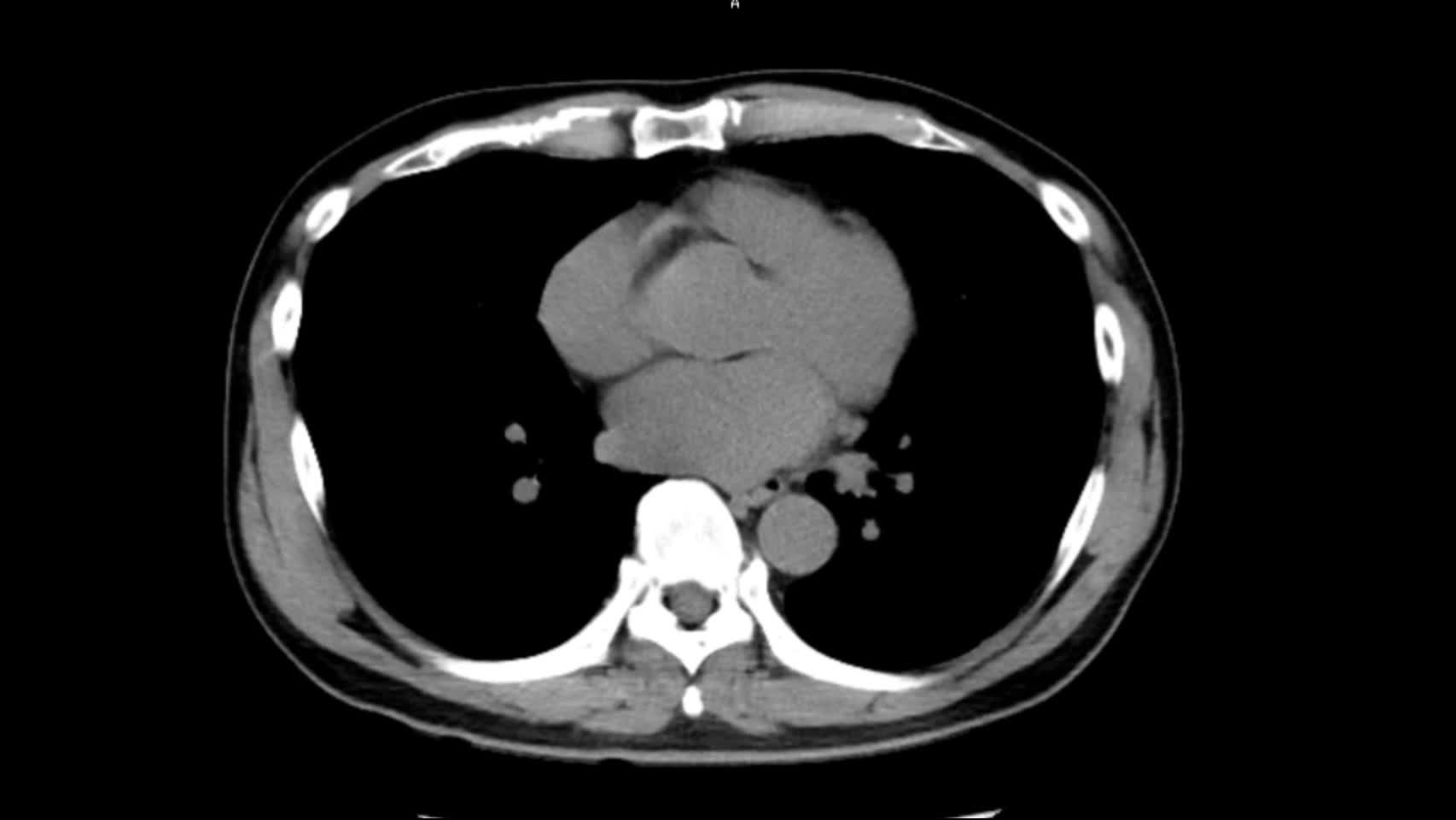 動画43-1　腹部単純CT
