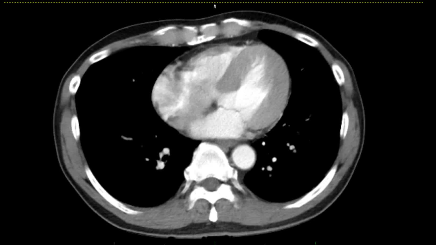 動画43-2　腹部造影CT