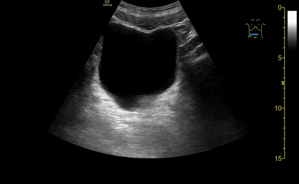 動画73-1　膀胱のエコー