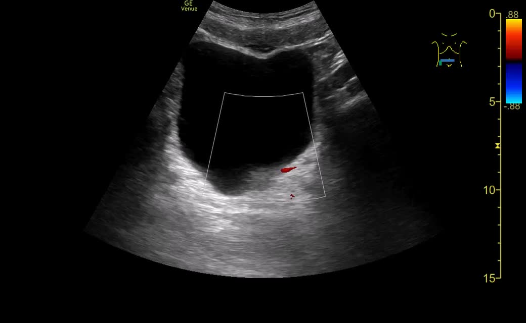 動画73-2　動画73-1と同一断面のカラードプラ...
