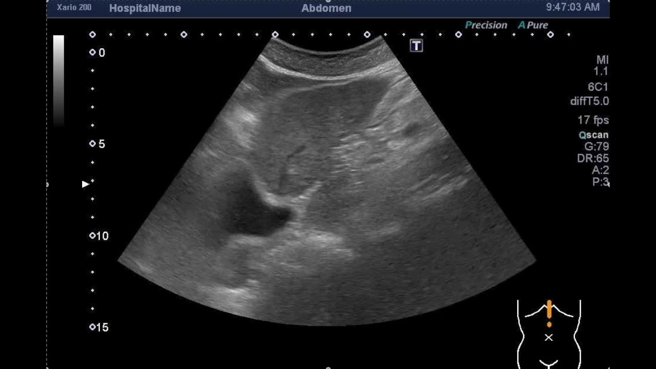 動画42-1　腹部エコー