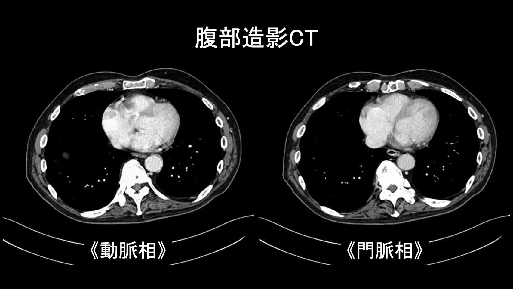 動画44-1　腹部造影CT