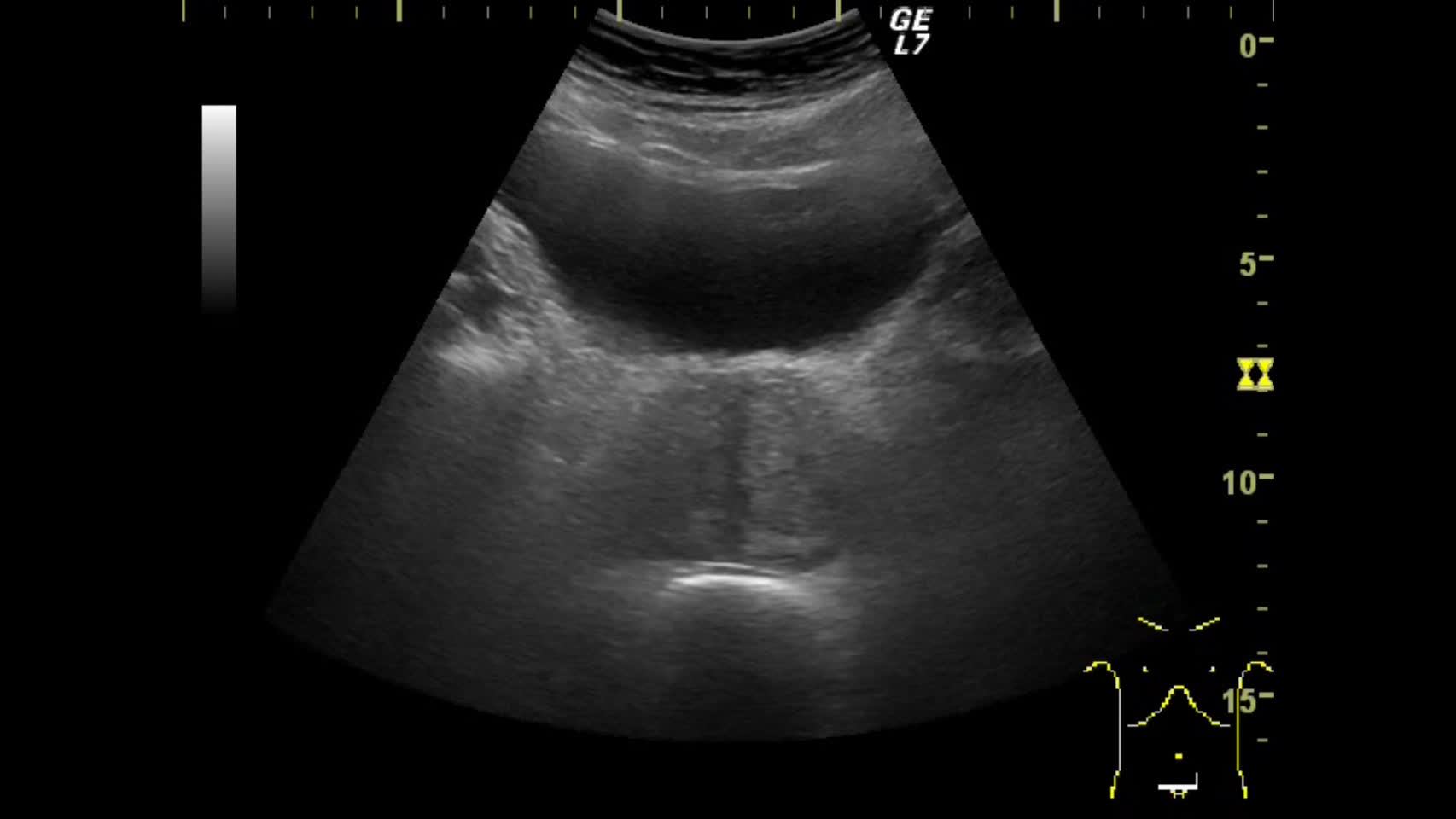 動画72-1　下腹部エコー