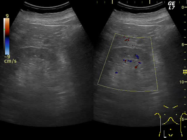 動画74-1　腎エコー