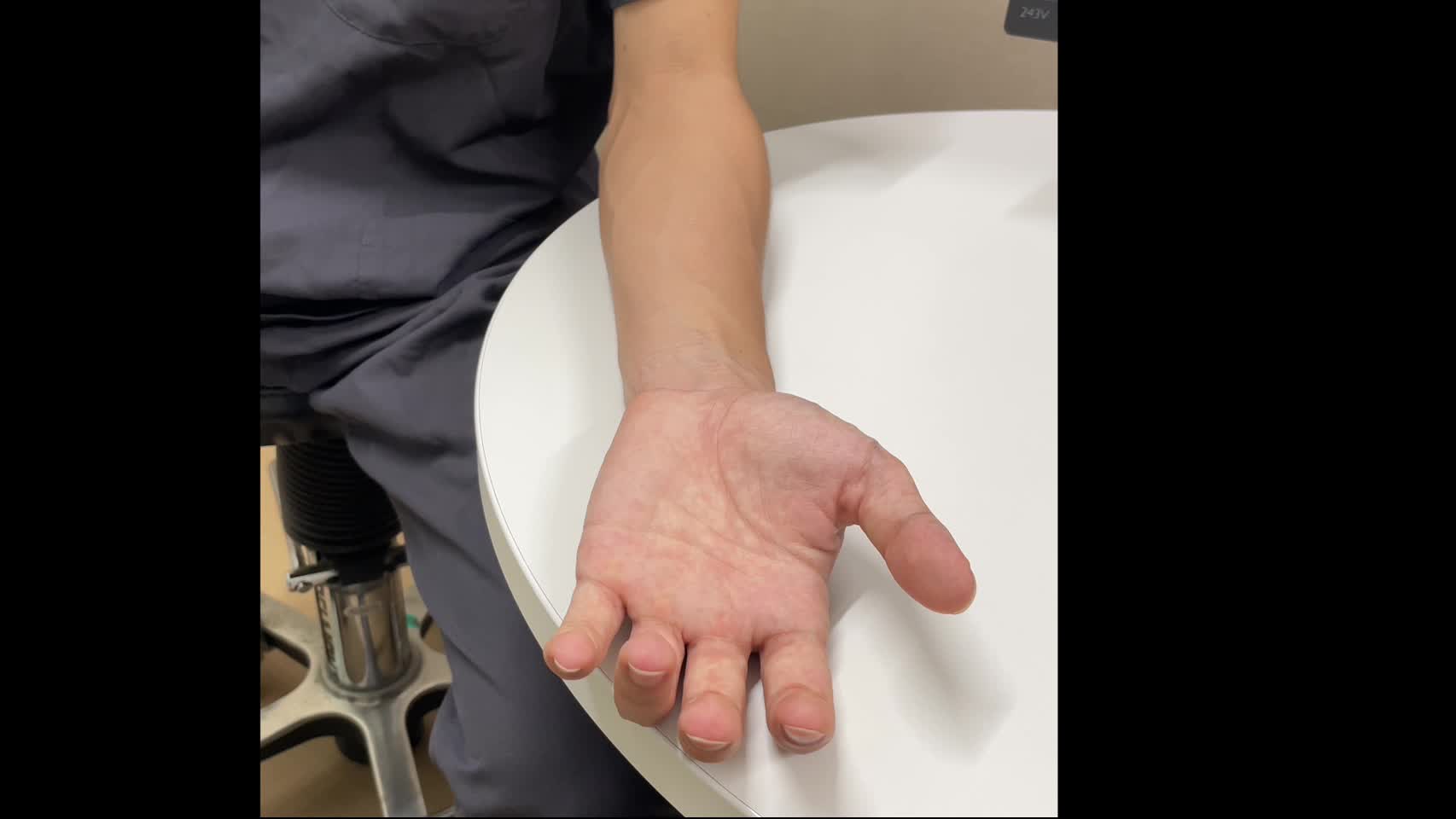 動画1　Tinel like sign 