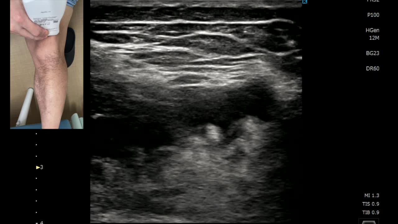 動画1　エコーガイド下関節穿刺 